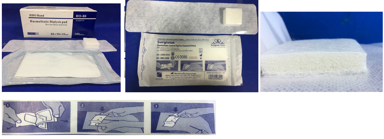 Hemostatic Pad for Radial Artery with Gelatin Sponge